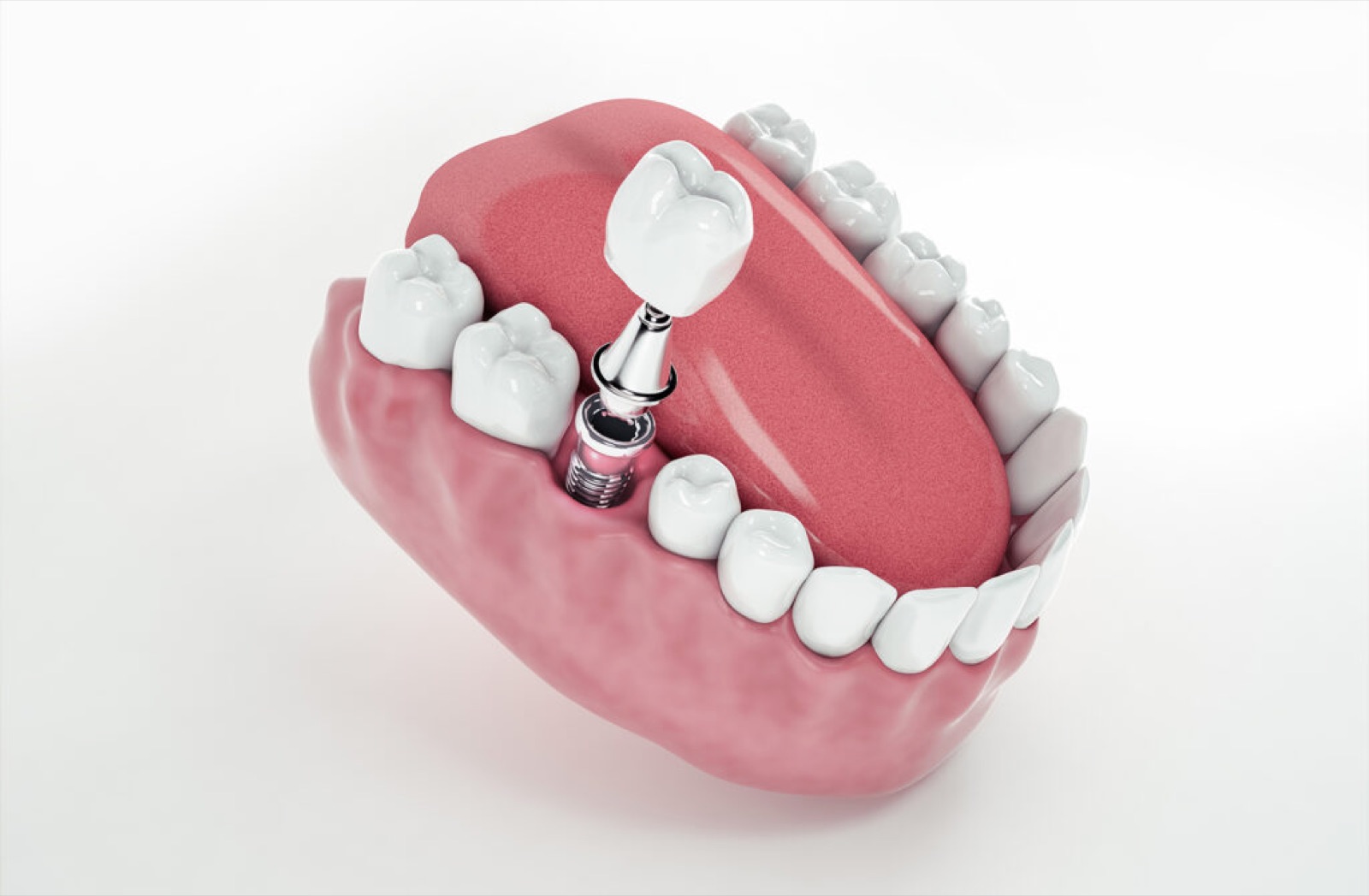 Paciente sorrindo após reabilitação com implantes na Amberget Odontologia