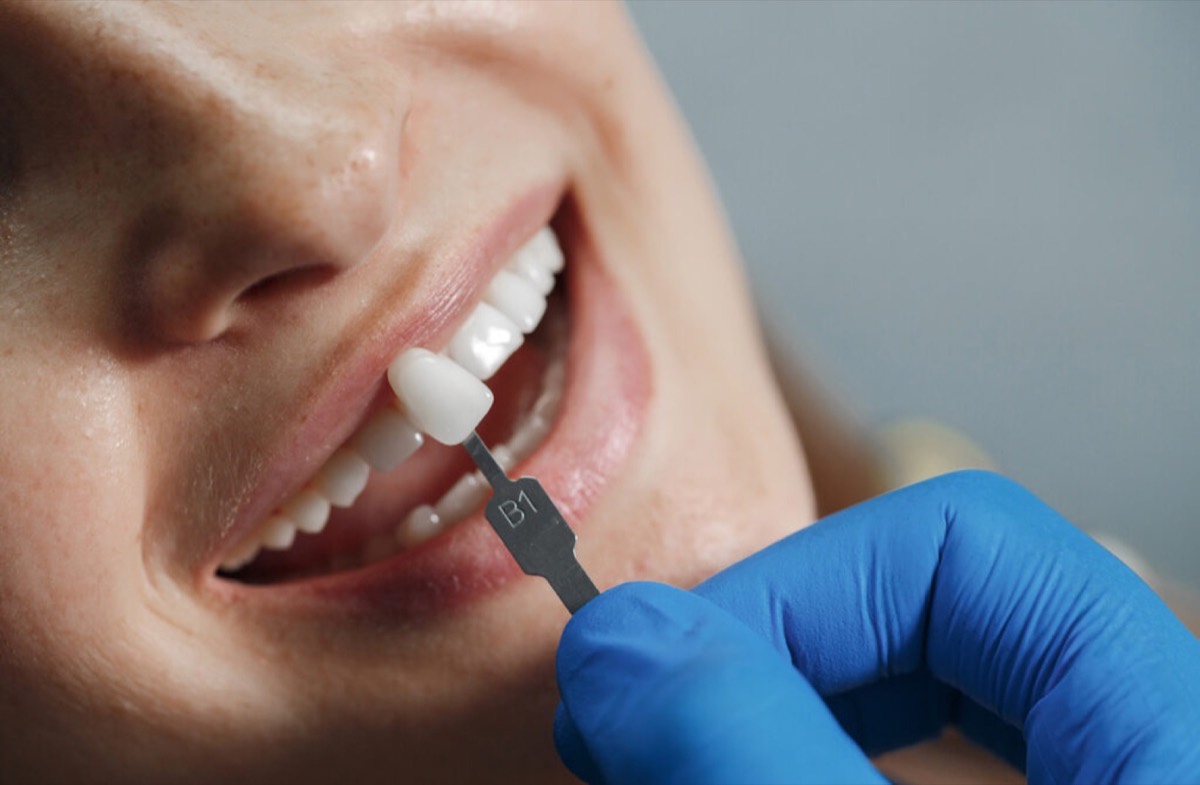 Sorriso com lentes de porcelana feito na Amberget Odontologia